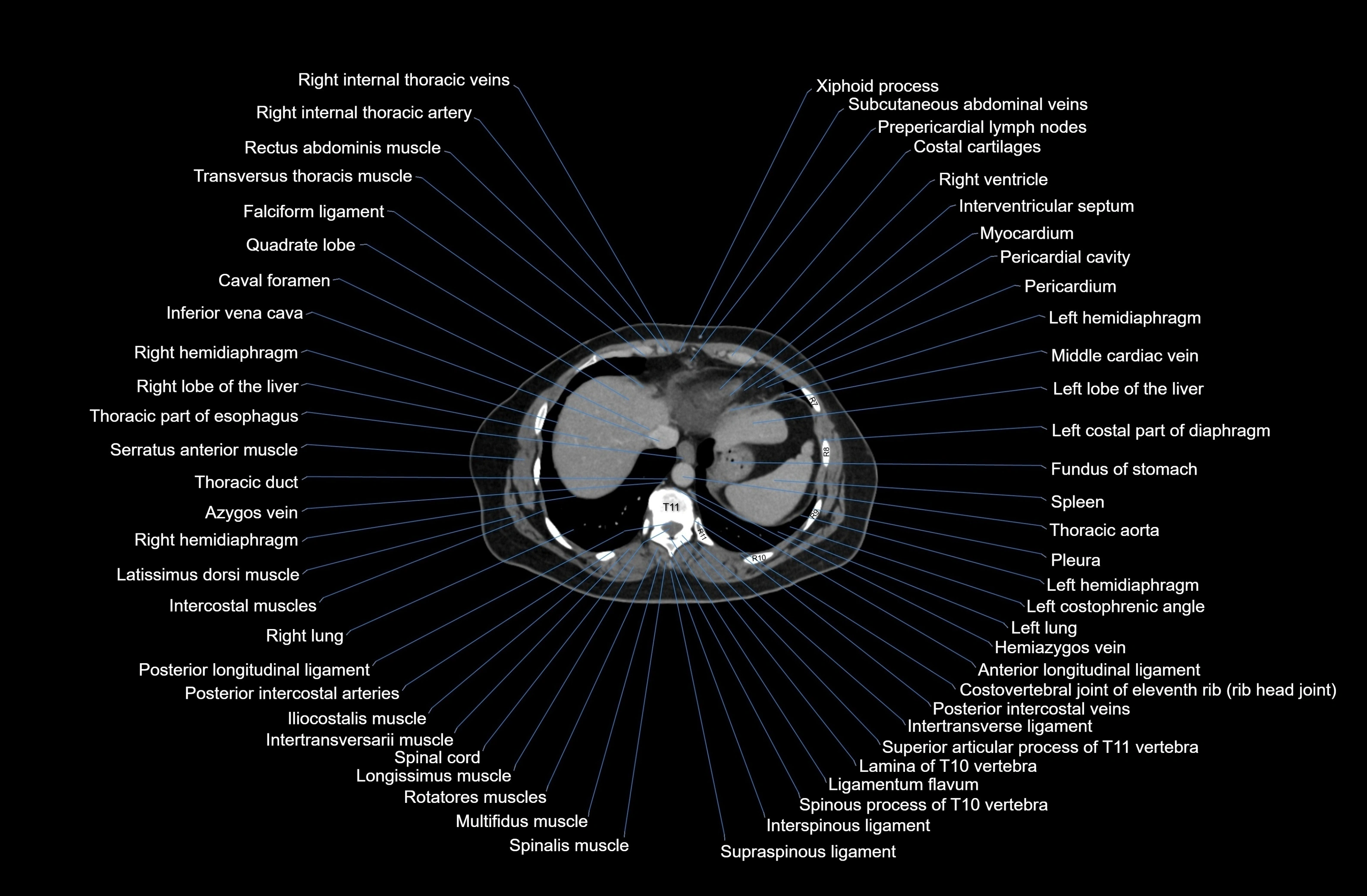CT Abdomen axial cross sectional anatomy labelled radiology image-00009.webp